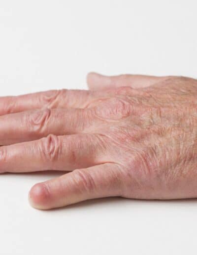 dokumentation af lillefinger ved personskade til forsikring