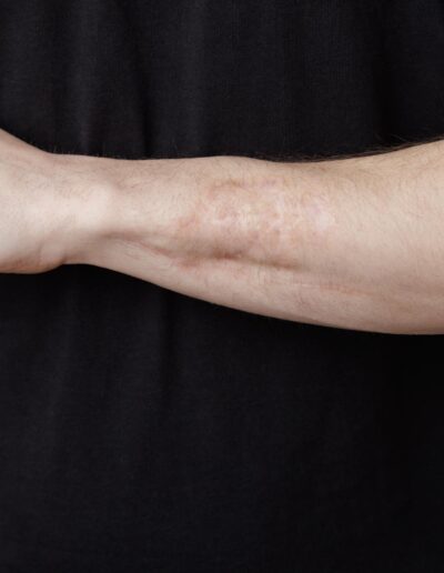 skade dokumenteret til vurdering af mengrad hos forsikring