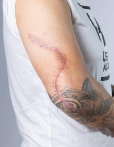 personskadefoto til mengradsvurdering