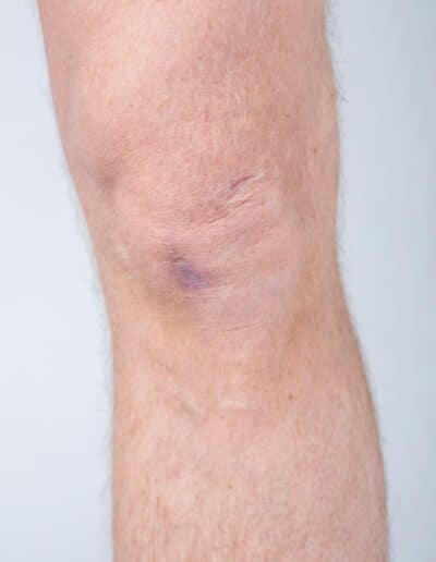 fotodokumentation af knæskade til brug for mengradsvurdering